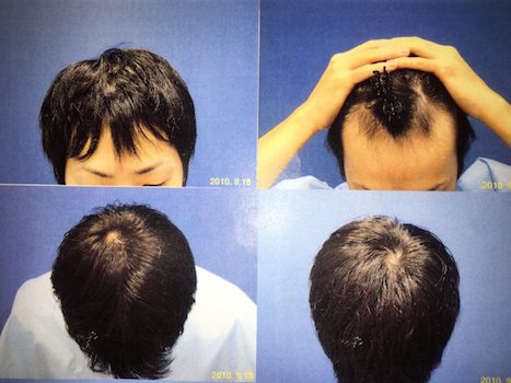 AGA治療初診時の頭皮