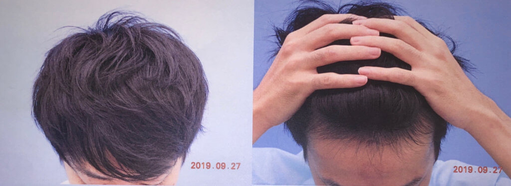 AGA治療　現在の頭皮写真