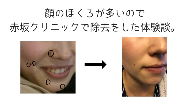 顔のほくろが多いので福岡の赤坂クリニックで除去をした体験談 30代女性の顔のほくろ除去体験記